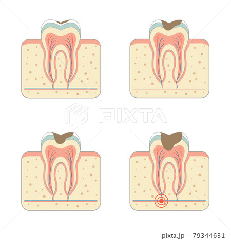 tooth decay disease tooth decay disease 79344631
