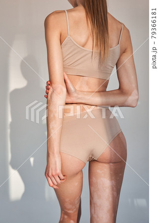Gorgeous naked woman showing nude back with vitiligo affected skin Gorgeous naked woman showing nude back with vitiligo affected skin 79366181