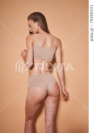 Woman with vitiligo skin posing at the underwear at the studio 79366341