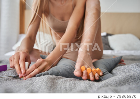 Woman with vitiligo disease applying colored nail polish at the bed at home 79366870