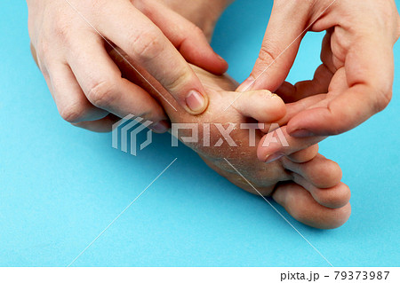 Fungus of foot close-up, isolated on blue background. The concept dermatology, treatment fungal and fungal infections in humans. Macro photograph human parasites. Rear background of a dermatologist Fungus of foot close-up, isolated on blue background. The concept dermatology, treatment fungal and fungal infections in humans. Macro photograph human parasites. Rear background of a dermatologist 79373987