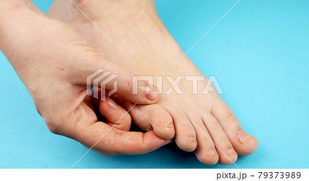 Fungus of foot close-up, isolated on blue background. The concept dermatology, treatment fungal and fungal infections in humans. Macro photograph human parasites. Rear background of a dermatologist Fungus of foot close-up, isolated on blue background. The concept dermatology, treatment fungal and fungal infections in humans. Macro photograph human parasites. Rear background of a dermatologist 79373989