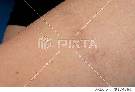 Varicose veins and capillary veins in the legs. Medical inspection and treatment 79374569