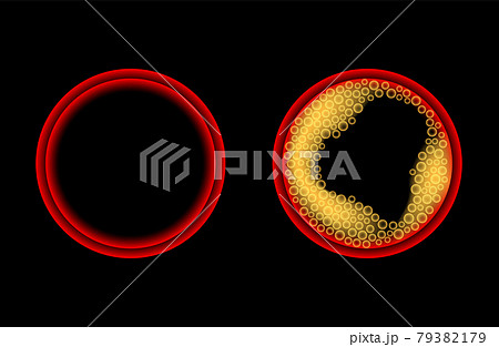 Cholesterol and atherosclerosis Cholesterol and atherosclerosis 79382179