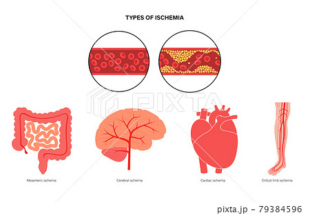 Types of ishemia Types of ishemia 79384596