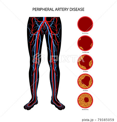 Peripheral artery disease 79385059