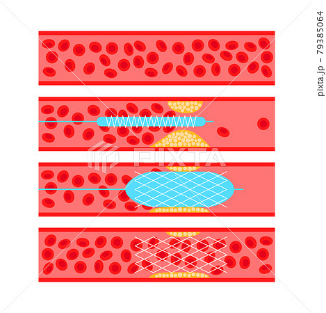 Angioplasty cardiac stent 79385064