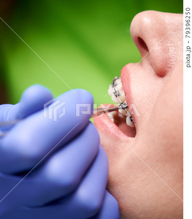 Orthodontist hands placing braces on woman teeth. Orthodontist hands placing braces on woman teeth. 79396250