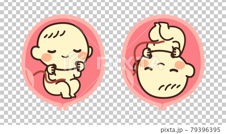 胎児　逆子　イラスト 79396395
