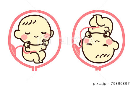 胎児　逆子　イラスト 79396397