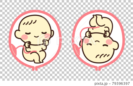 胎児　逆子　イラスト 79396397