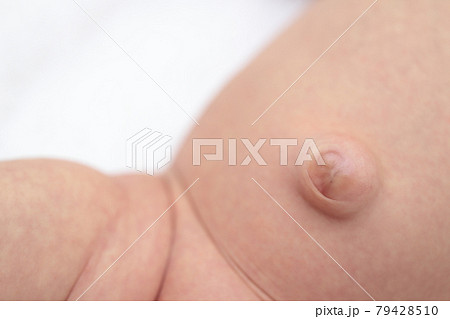 臍ヘルニアの赤ちゃんのおへそ 79428510