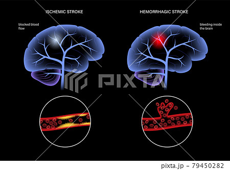 Brain stroke ishemic and hemorrhagic 79450282