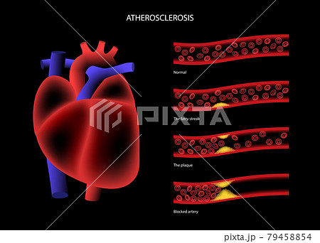 Cholesterol heart disease 79458854