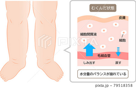 足のむくみ　水分量のバランス　肌の断面図 79518358
