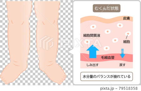 足のむくみ　水分量のバランス　肌の断面図 79518358