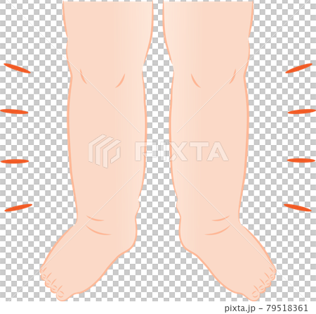 足のむくみ 足のむくみ 79518361