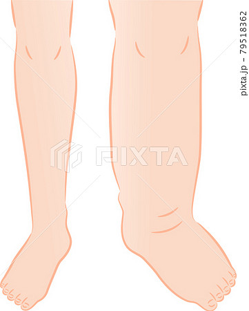 足のむくみ ビフォアアフター 足のむくみ ビフォアアフター 79518362