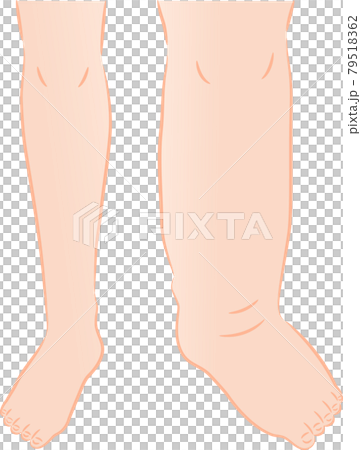 足のむくみ ビフォアアフター 足のむくみ ビフォアアフター 79518362