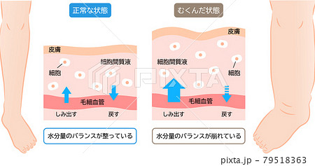 足のむくみ　水分量のバランスのしくみ　肌の断面図　ビフォアアフター 79518363