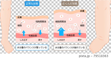 Swelling of the legs, how the water content is balanced, cross-sectional view of the skin, before and after 79518363