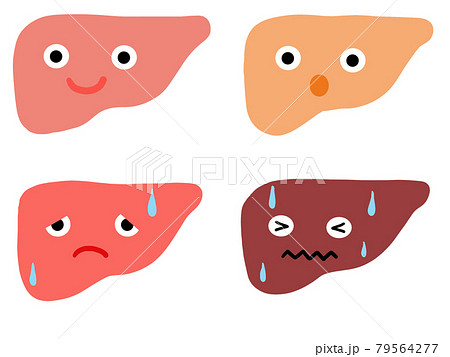 肝臓の病気 重症度4つのイラスト 肝臓の病気 重症度4つのイラスト 79564277