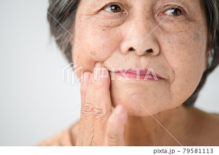 シニア女性 ほうれい線 エイジングケア シニア女性 ほうれい線 エイジングケア 79581113