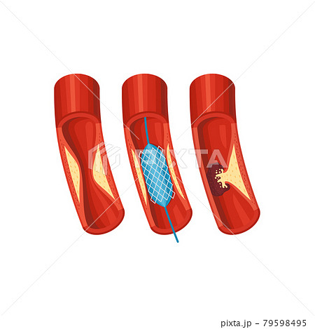 Aorta Diseases Illustration 79598495