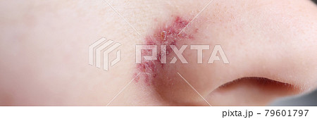 On wings of nose, skin after removal of vascular mesh 79601797