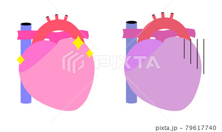 心臓のシンプルなイラスト。健康なものと不健康なものの二つ。 79617740