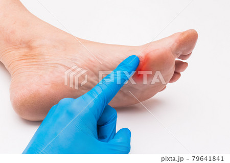 A doctor's hand in a protective medical glove touches his hand with a finger and examines the wound on the foot of an elderly woman on a white background. Medical concept A doctor's hand in a protective medical glove touches his hand with a finger and examines the wound on the foot of an elderly woman on a white background. Medical concept 79641841