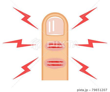 指先の「ひび」と「あかぎれ」 79651207