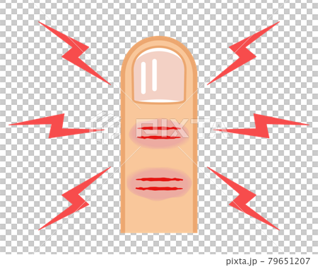 指先の「ひび」と「あかぎれ」 79651207