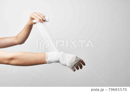 fracture arm injury medicine plaster cast close-up fracture arm injury medicine plaster cast close-up 79665570