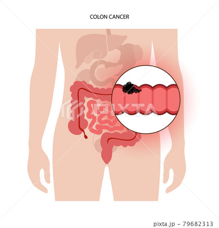 Colon cancer stage 79682313