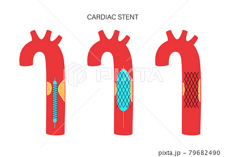 Angioplasty cardiac stent Angioplasty cardiac stent 79682490