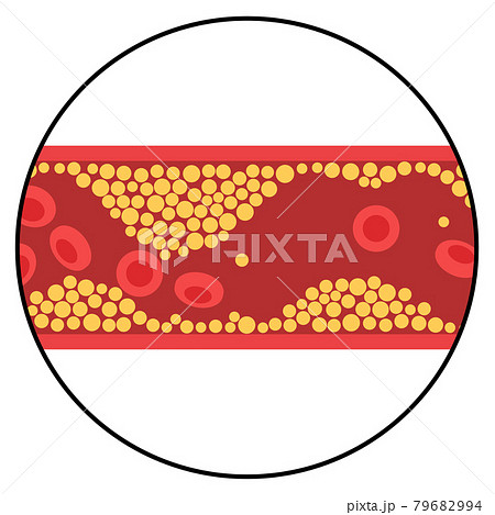 Cholesterol and atherosclerosis 79682994
