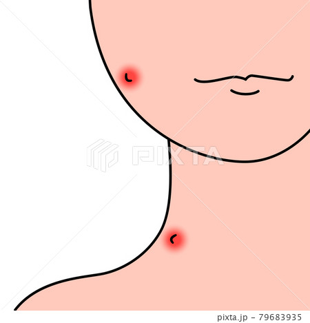 顔 首 虫さされ かゆい かゆみ 腫れる イラスト素材のイラスト素材