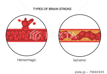 Brain stroke ishemic and hemorrhagic 79684945