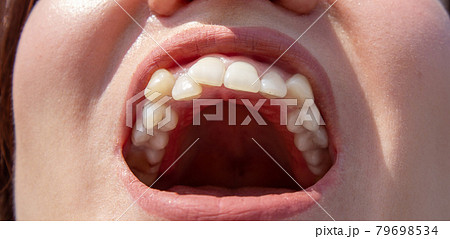 Curved female teeth, before installing braces Close - up Curved female teeth, before installing braces Close - up 79698534