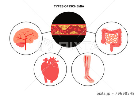 Types of ishemia Types of ishemia 79698548