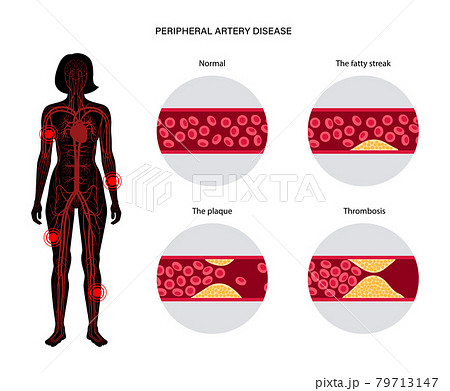 Peripheral artery disease Peripheral artery disease 79713147