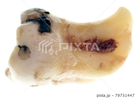 Wisdom tooth 79731447