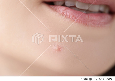 Closeup of white pimple on chin skin of young woman Closeup of white pimple on chin skin of young woman 79731789