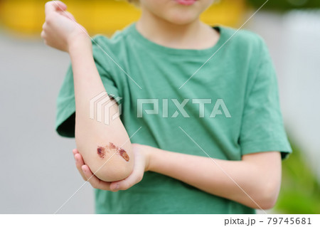 Cute little boy looking on his elbow with wound. Child healthcare and medicine concept. First aid. Cute little boy looking on his elbow with wound. Child healthcare and medicine concept. First aid. 79745681