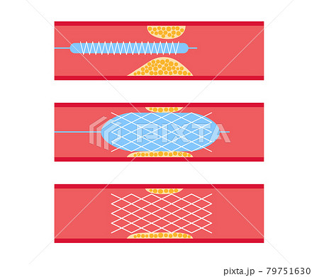 Angioplasty cardiac stent 79751630