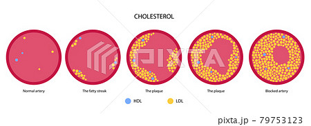 Cholesterol blood artery Cholesterol blood artery 79753123