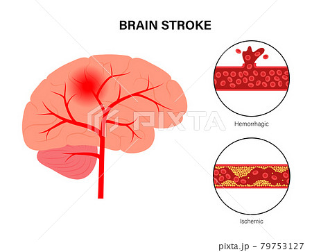 Brain stroke ishemic and hemorrhagic 79753127