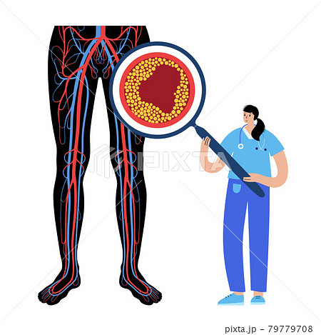 Peripheral artery disease 79779708