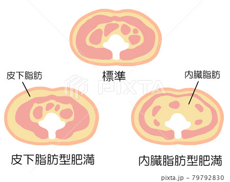 内臓脂肪型肥満と皮下脂肪型肥満の比較イラストのイラスト素材 7979